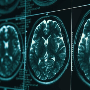 Η ασύρματη ακτινοβολία και η νόσος Alzheimer: νέα στοιχεία για τον ρόλο του οξειδωτικού στρες και της πρωτεϊνικής μετουσίωσης