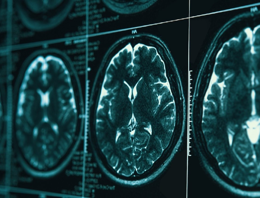 Alzheimer anthro Η ασύρματη ακτινοβολία και η νόσος Alzheimer: νέα στοιχεία για τον ρόλο του οξειδωτικού στρες και της πρωτεϊνικής μετουσίωσης